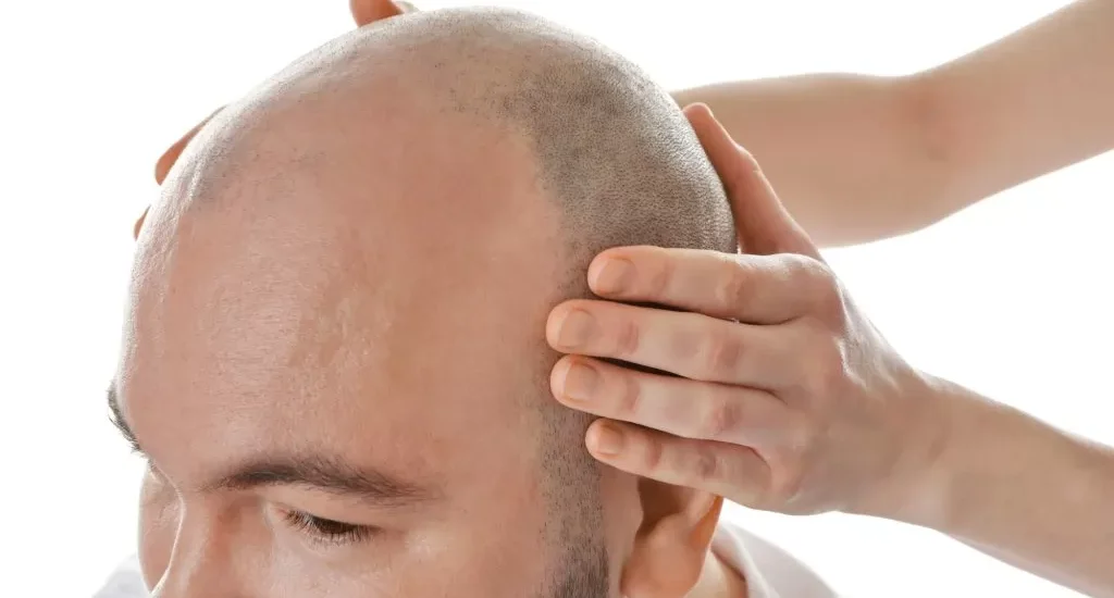 Metoda przeszczepu włosów FUT – na czym polega?